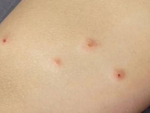 Cách xử lý khi bị rệp giường cắn